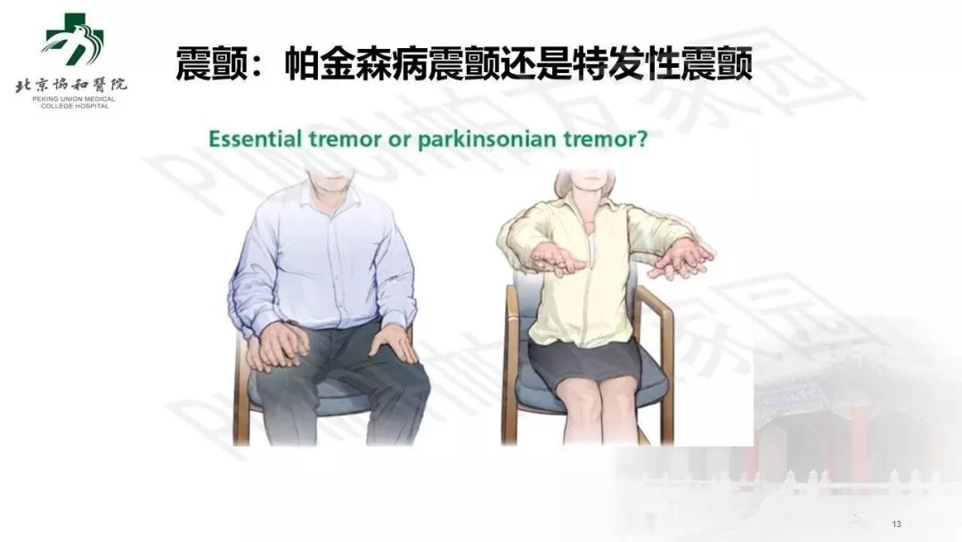 手抖就是帕金森病嗎？臨床常見的 4 個誤區(qū)